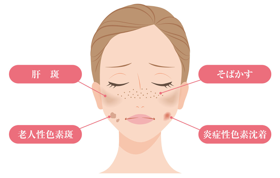顔のシミやそばかすの種類を示したイラスト。肝斑、そばかす、老人性色素斑、炎症性色素沈着の位置が示されています