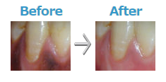 歯茎のメラニン色素除去の施術前後