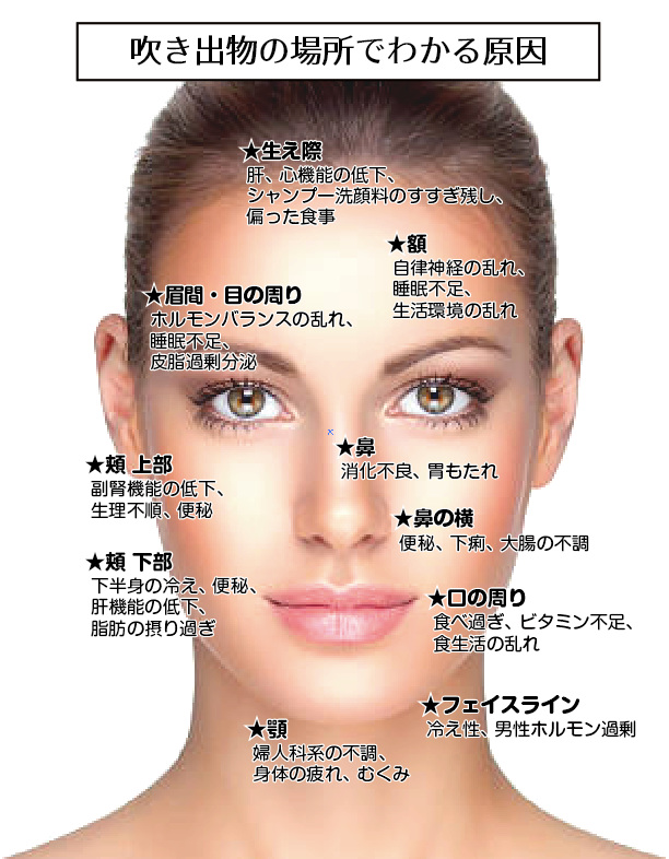 顔にできる吹き出物の位置とその原因を示すイラスト