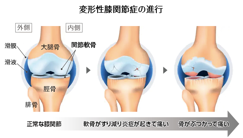 正常な膝関節から、骨同士がぶつかる痛みの発症に至るまでの変形性膝関節症の進行を描いたイラスト