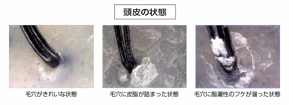 頭皮の状態を比較した画像。健康な毛穴と皮脂詰まり、フケの状態を示す